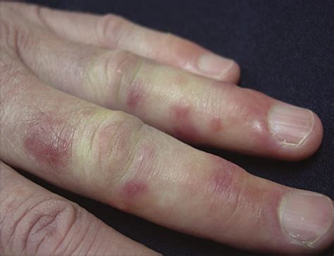 Tender Papules On The Hands—quiz Case Dermatology Jama Dermatology