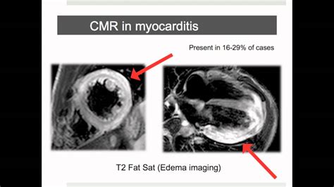 The mri myocarditis protocol encompasses a set of different mri sequences for the cardiac assessment in case of suspected myocardial inflammation. Why CMR Webinar: Introduction into Inflammatory ...