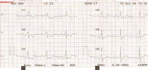 Ecg Of The First Patient Precordial Ecg Leads Showing Signs Of Rbbb