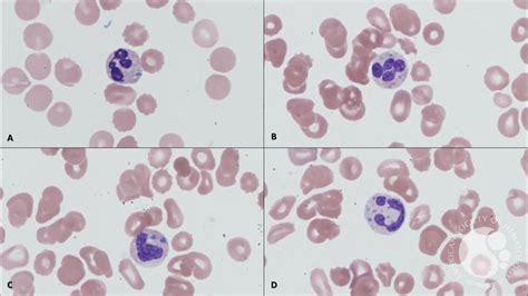 Green Neutrophilic And Monocytic Inclusions As A Dire Prognostic