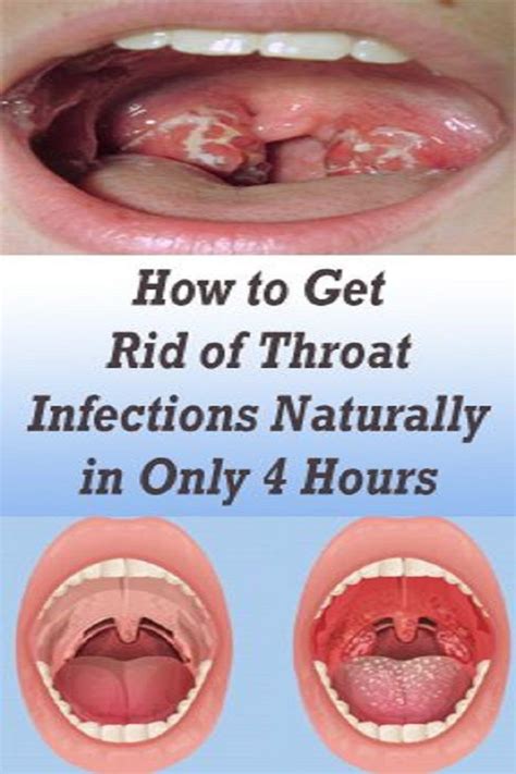 How To Get Rid Of Throat Infections Naturally In Only 4 Hours Throat