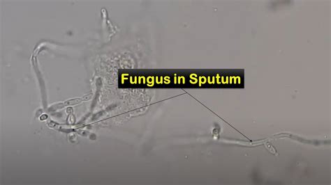 Sputum In KOH Mount Showing Fungal Elements YouTube