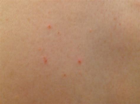 Red Spots On One Side Of Body Hurt Pelajaran
