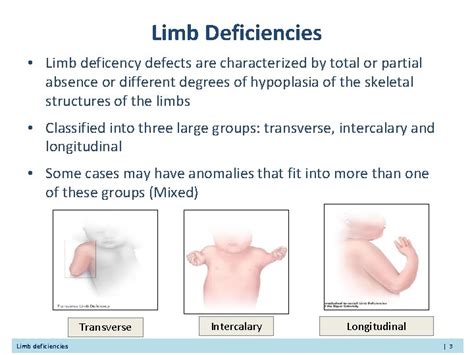 Congenital Limb Deficiencies Limb Reduction Defects Presenter Learning