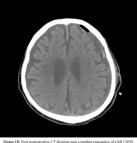 Figure 1 From Contralateral Delayed Acute Subdural Hematoma Following
