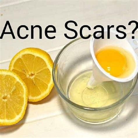 How To Treat Acne Scars With Lemon Juice Heal Info
