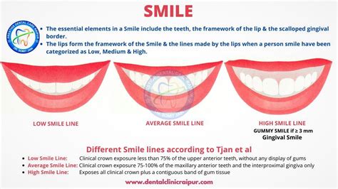 Classical Approach To Gummy Smile Lip Lowering Surgery