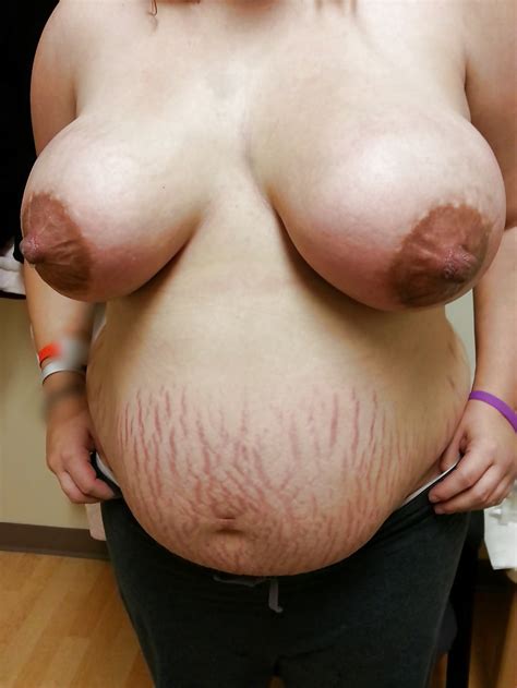 Big Nippled Women With Stretch Marks Or Scars 49 Pics Xhamster