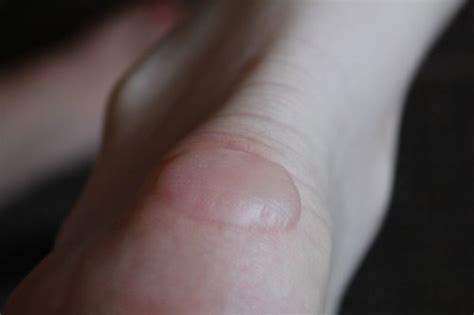 Blisters Between Toes