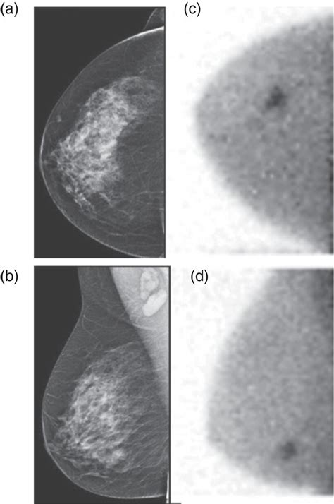 A Correlative Approach To Breast Imaging Radiology Key