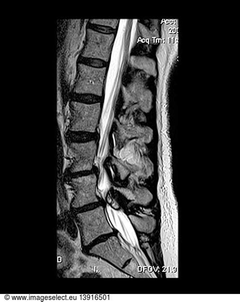 Synovial Cyst With Spinal Stenosis Synovial Cyst With Spinal Stenosis