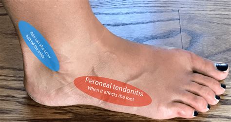Peroneal Tendonitis Almawi Limited The Holistic Clinic