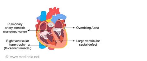 Congenital Heart Defects Causes Symptoms Diagnosis And Treatment