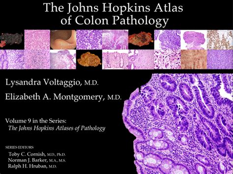 Hopkins Gi Pathology On Twitter The Jhh Atlas Of Colon Pathology Is