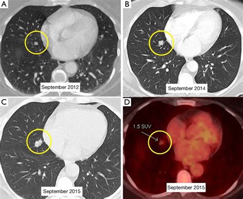 Enlarging Lung Nodule Lung Carcinoid A Axial Ct Scan Of The Chest