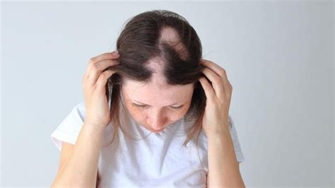 Things To Know About Alopecia Areata SuccessYeti