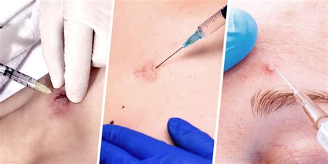 Corticosteroid Injection For Keloid Scars Premier Clinic