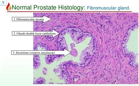 Pathology Of Prostate Benign