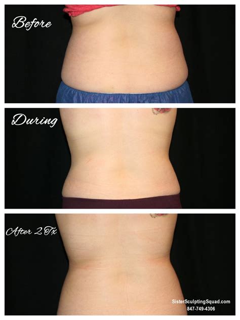 Coolsculpting Before After Photos Riverside Medical S C