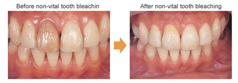 Teeth Bleaching