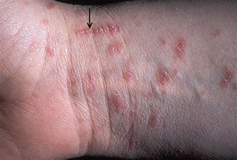 Scabies Burrows After Treatment