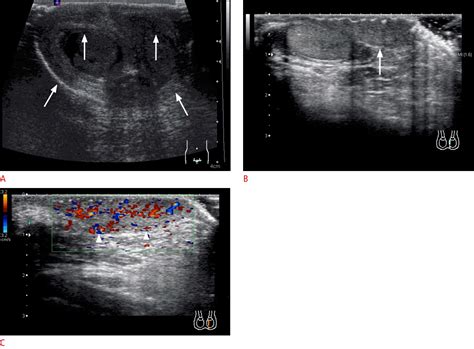 Scrotal Edema Ultrasound