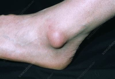 Bursa On Ankle Stock Image M120 0127 Science Photo Library