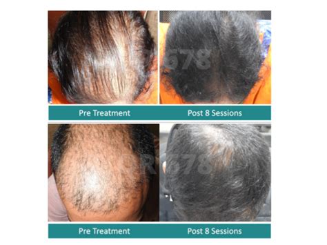Who Is The Best Hair Loss Specialist 27f Chilean Way
