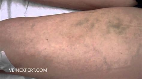 Large Varicose Vein Treated With Foam Sclerotherapy By Dr Jc Agostini