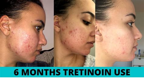 Tretinoin Cream Before And After Acne