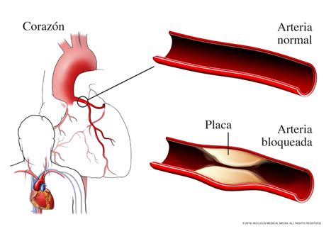 Enfermedad Coronaria NHLBI NIH