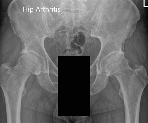 Case Study Left Hip Total Replacement In 54 Year Old Female