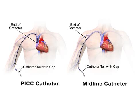 Picc Line Vs Midline Catheter Nursing Pinterest