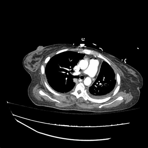 An exudative pleural effusion occurs when there is increased permeability of the pleural surface bilateral effusions with an enlarged heart shadow are commonly caused by congestive cardiac failure. Differential Diagnosis of Pleural Effusion