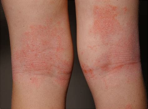 Typical Lichenified Atopic Dermatitis In The Kneefolds Download