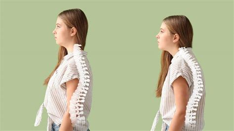 Posture Perfect Get Rid Of That Dowager Hump Hunched Over Appearance Richmond Chiropractor