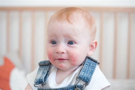 Manchas Blancas En La Cara Un Síntoma De La Dermatitis Atópica Bebé