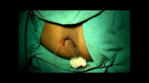 Epidemiology incidence is estimated at ~1:10,000. KSHAR SUTRA TREATMENT- RECURRENT FISTULA IN ANO,BY DR ...