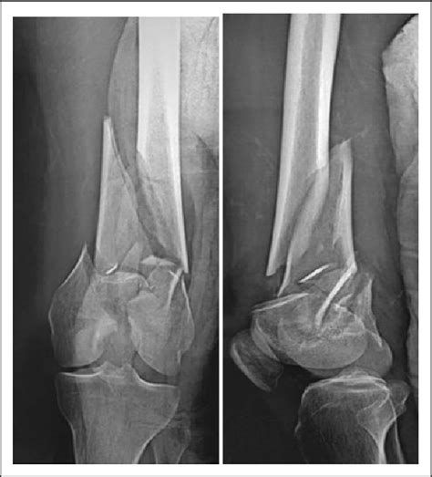 Preoperative Anteroposterior And Lateral X Rays Of Comminuted