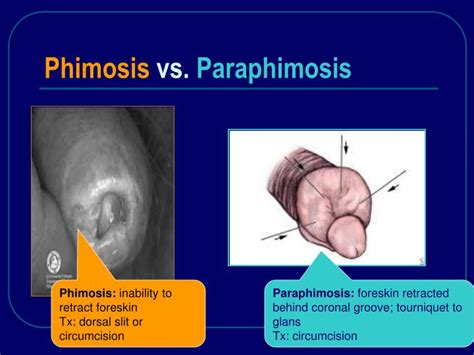 Paraphimosis Treatment Youtube