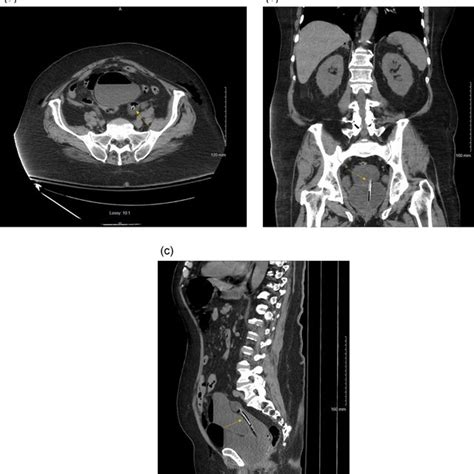 Ct Abdomen And Pelvis Without Contrast Demonstrated In Transverse A