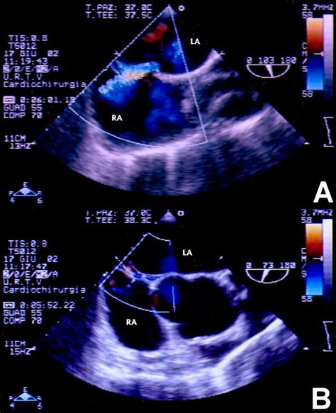 Multiplane Color Doppler Tee The Diagnosis Of Pfo Was Advanced With