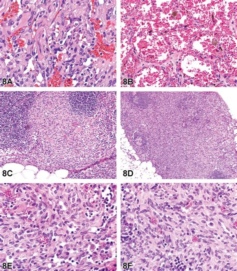 Angiomatous Lesions In The Mesenteric Lymph Nodes Of Male Wistar Han
