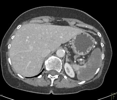 Splenic Infarct Spleen Case Studies Ctisus Ct Scanning