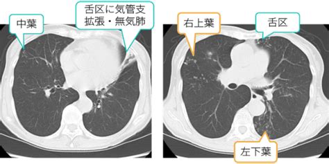 有关历史、生物、科技、人文、地理、生活等所有话题。 not a satire/meme sub, english speakers please refer to rule 7. 【CT画像あり】非結核性抗酸菌症(NTM)とは？原因菌、症状、診断 ...