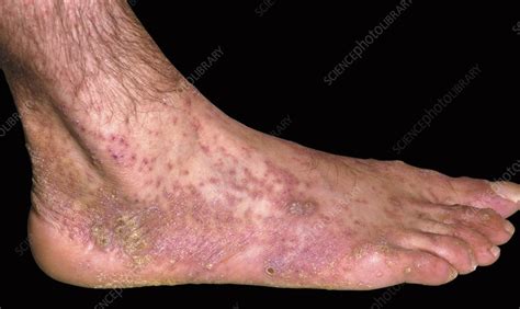 Skin In Reiter S Syndrome Stock Image C Science Photo Library