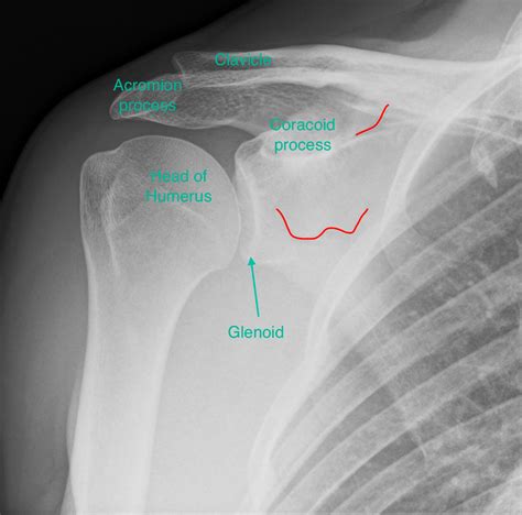 Right Scapula Fracture
