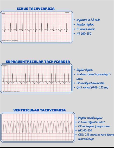 Tachycardia Ekg Rhythm Strips Etsy