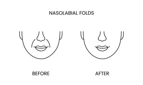 50 Nasolabial Folds Illustrations Royalty Free Vector Graphics And Clip