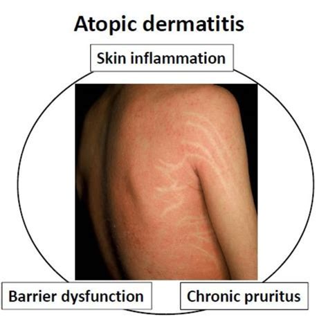 Pdf Pathogenesis Of Atopic Dermatitis Current Paradigm